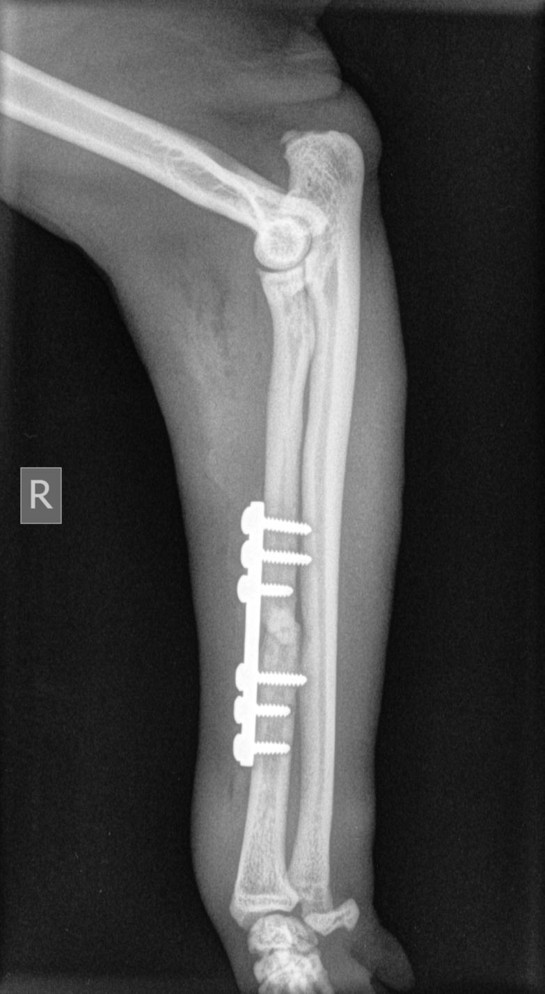 Breuk na chirurgie Breuk na chirurgie